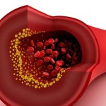 Closeup view of cholesterol plaque in blood vessel