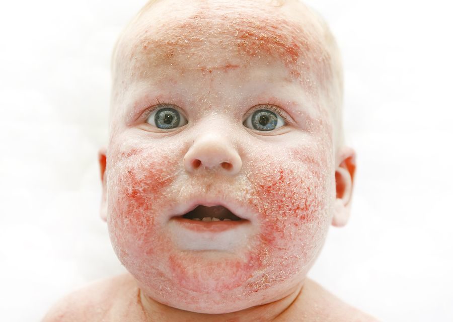 Can You Prevent Allergic Skin Reactions in Babies?