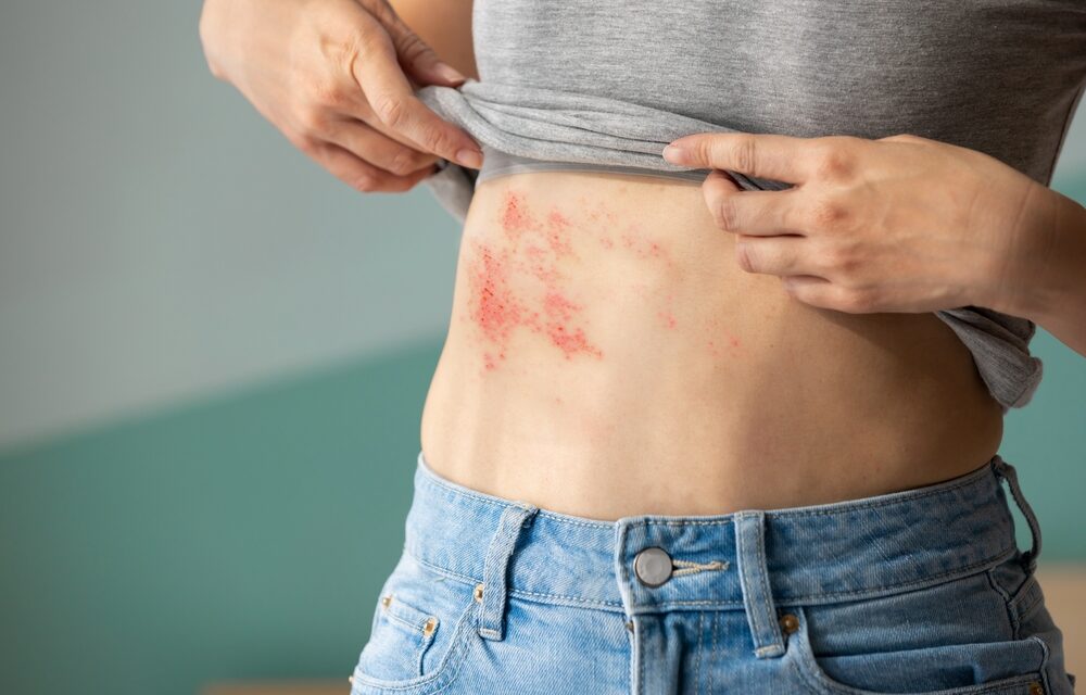 Vitamin C and Shingles