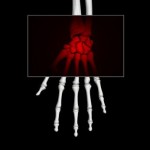 CRPS occurs after surgery or an injury