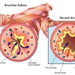 asma bronchiale