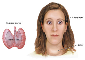 hyperthyroid