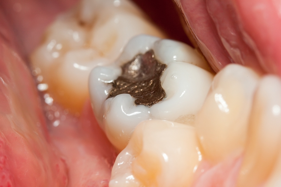 Are Mercury Fillings Toxic?