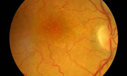 Macular Degeneration, Sunlight and Antioxidants