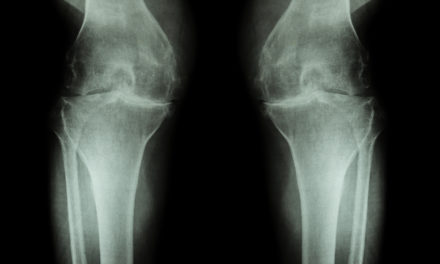 Could this be an Inexpensive way to Prevent Arthritis?