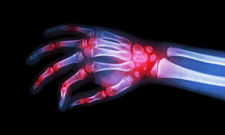Rheumatoid Arthritis and Omega-3 Fatty Acids