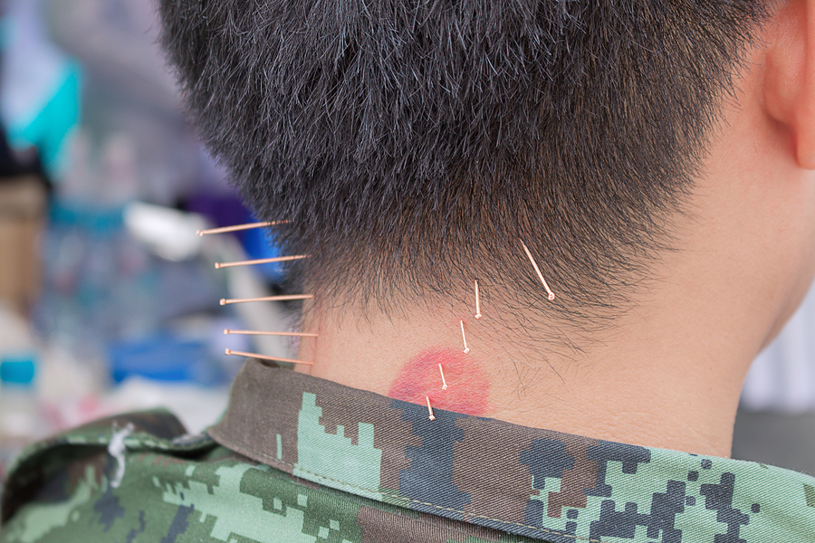 PTSD and Acupuncture