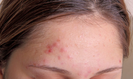 Acne and Barberry