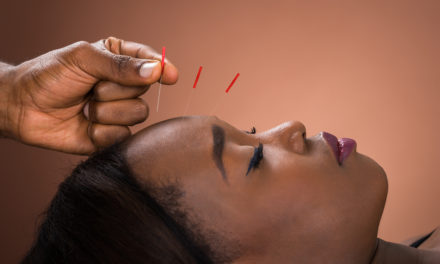 Acupuncture to Prevent Migraines