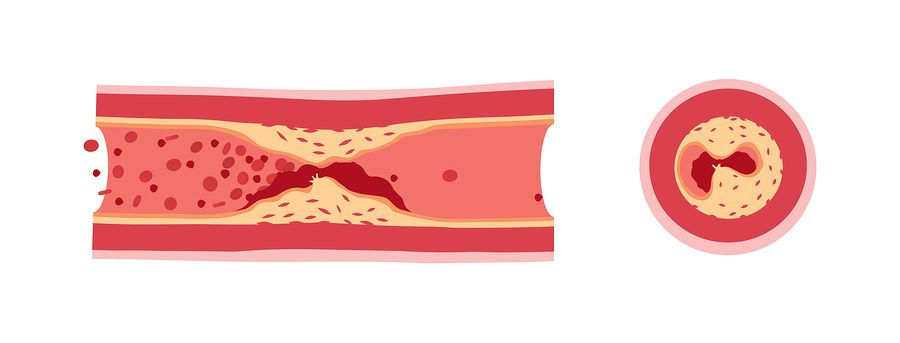 Vitamin K and Arterial Calcification
