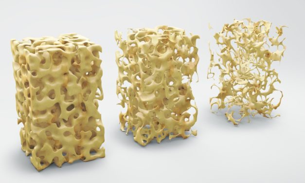 Improving Bone Mass in Celiac Disease Patients