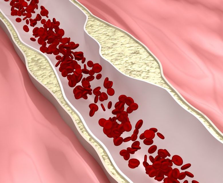 Vitamin D and Coronary Artery Disease