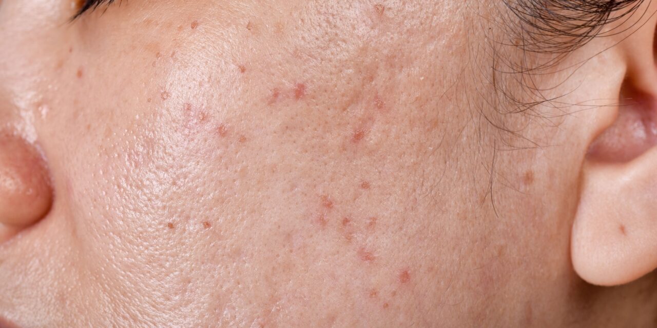 Vitamin A and E Deficiency Linked to Acne Severity: 2006 Study Findings
