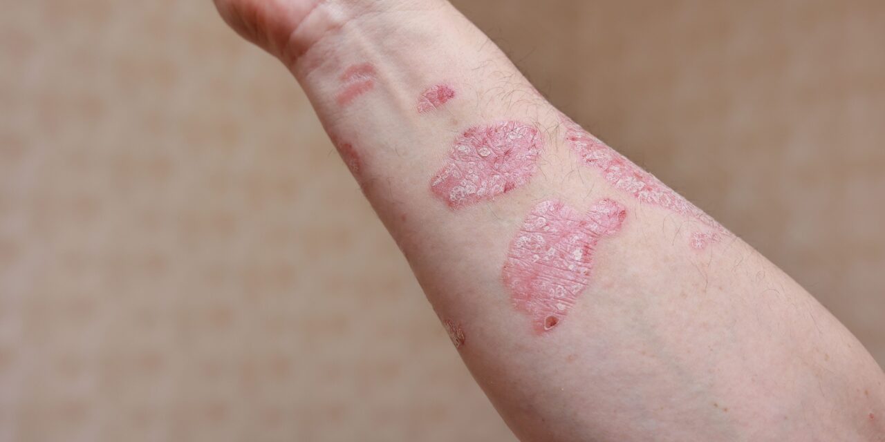 “Nutrition and Psoriasis: How Vitamin D, Fish Oil, Gluten-Free Diets, and B-Vitamins May Help”