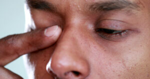 Close-up of irritated eyes; vitamin A supports the tear film and mucous membranes that protect against pollen irritation.