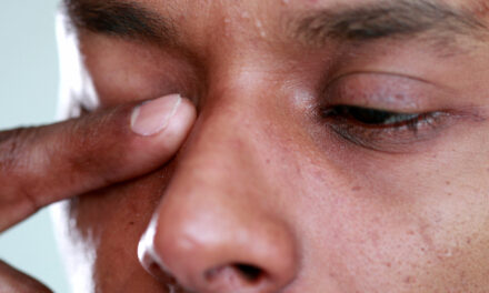 What to do About Itchy Allergy Eyes